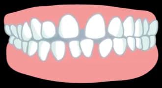 severe teeth